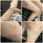 Bedbugs warning for hotels in Kabukicho