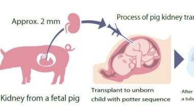 Japan team seeks approval for pig kidney transplant to human fetus